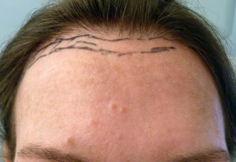 Abaissement De La Ligne Capillaire Lowering Hairline Or Advancement